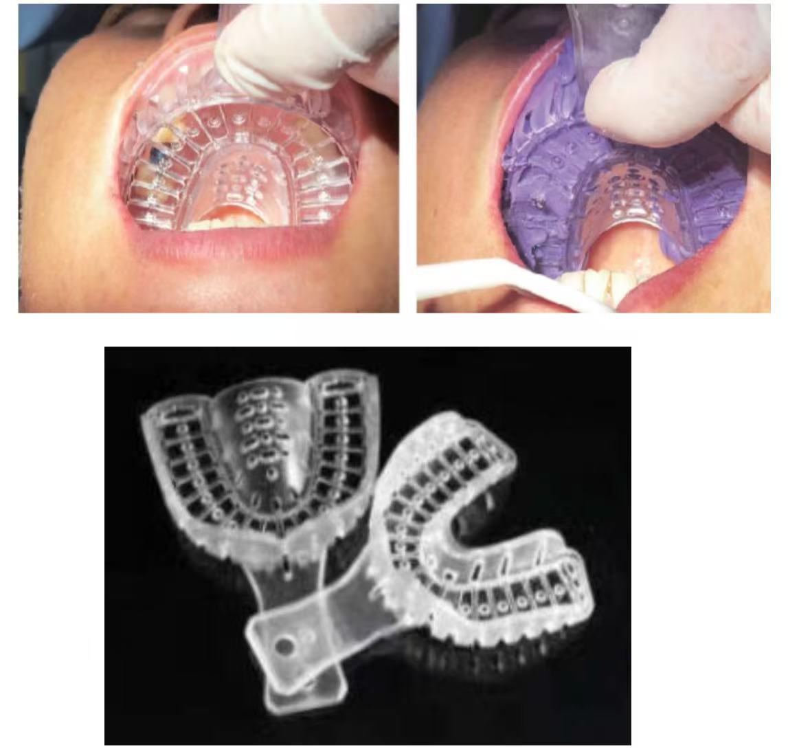 Dental Implant Tray
